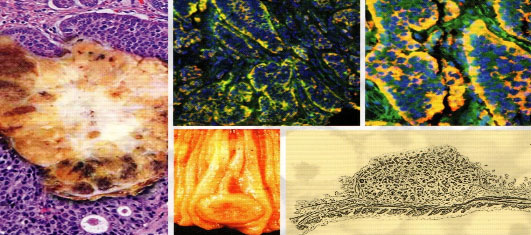 Immagine Tumori Neuroendocrini